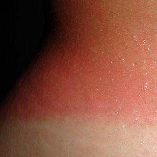 Thai sunburn number two.